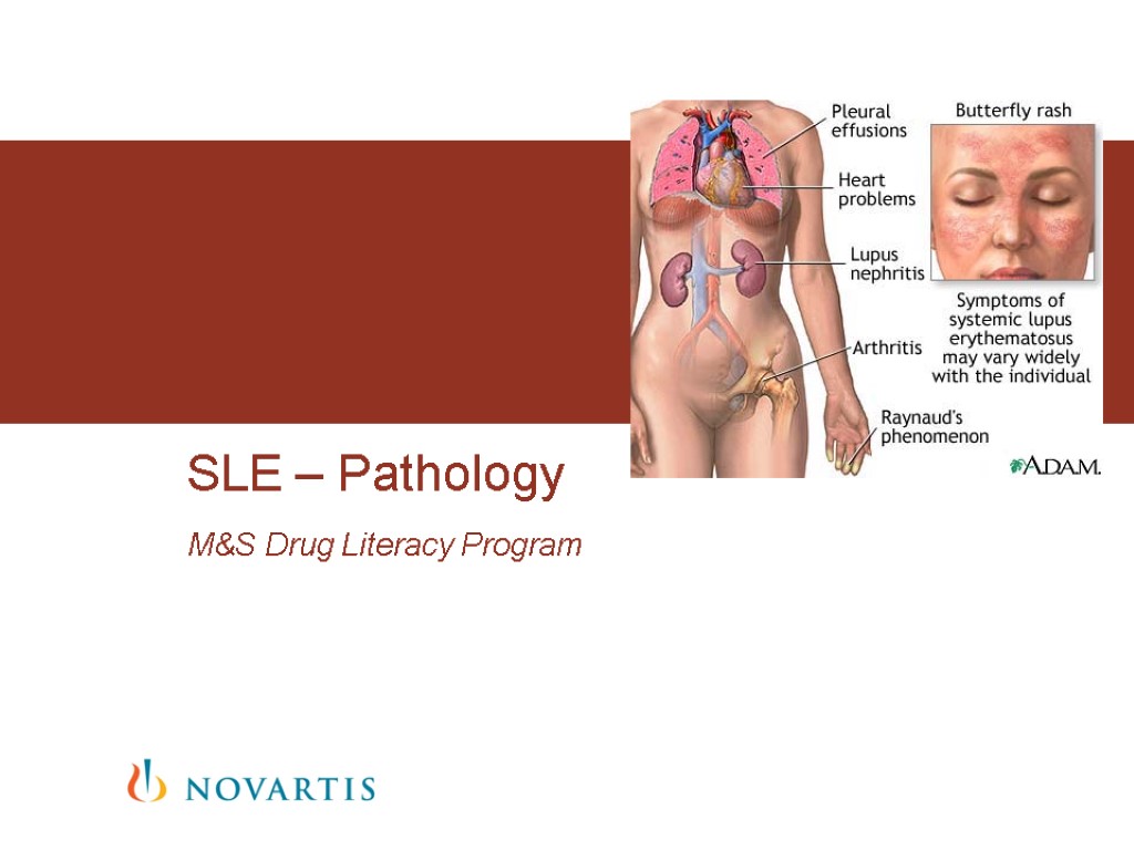 M&S Drug Literacy Program SLE – Pathology